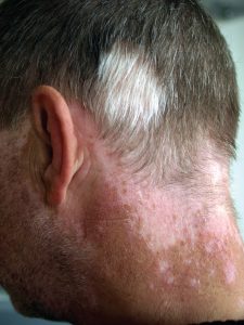 This photo shows the back of a man’s neck. There is a large, discolored patch of skin at the base of his hairline. The discolored area extends over the ears onto the cheeks, toward the front of the face. The man’s head and facial hair are mostly gray, but white patches of hair are seen above the discolored skin.