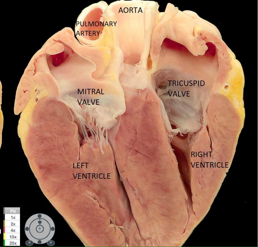 Frontal view of the heart with the aorta, pulmonary artery, and both ventricles visible