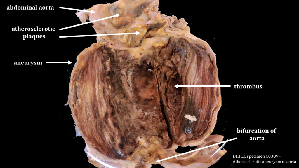 The abdominal aorta is opened at the level of the aneurysm, exposing the inside. The aneurysm has many layers, like an onion, with a dark blood clot (thrombus) just off the centre. The bottom of the aorta shows the bifurcation to the common iliac arteries. The top of the image shows the abdominal aorta dotted with yellow white atherosclerotic plaques