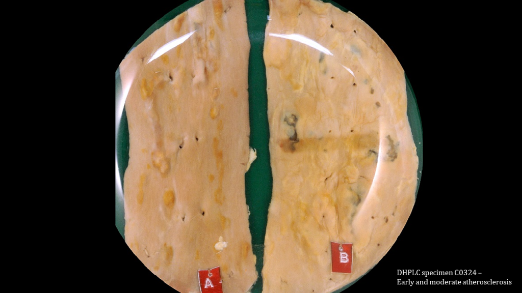 Two specimens of aorta, cut so that the intimal space is visible. The left aorta is a relatively normal aorta with early changes with yellow/orange/white streaks on the relatively smooth intimal surface. The right aorta is an aorta with moderate atherosclerosis with more yellow/orange/white streaks but the surface is more bumpy/shaggy