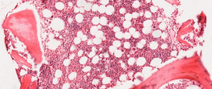 A sample of bone marrow is presented with chunks of bone (in bright red with sparse purple dots) surrounding a dense field filled with many large white circles (adipocytes) and numerous pink cells with dark purple nuclei within.