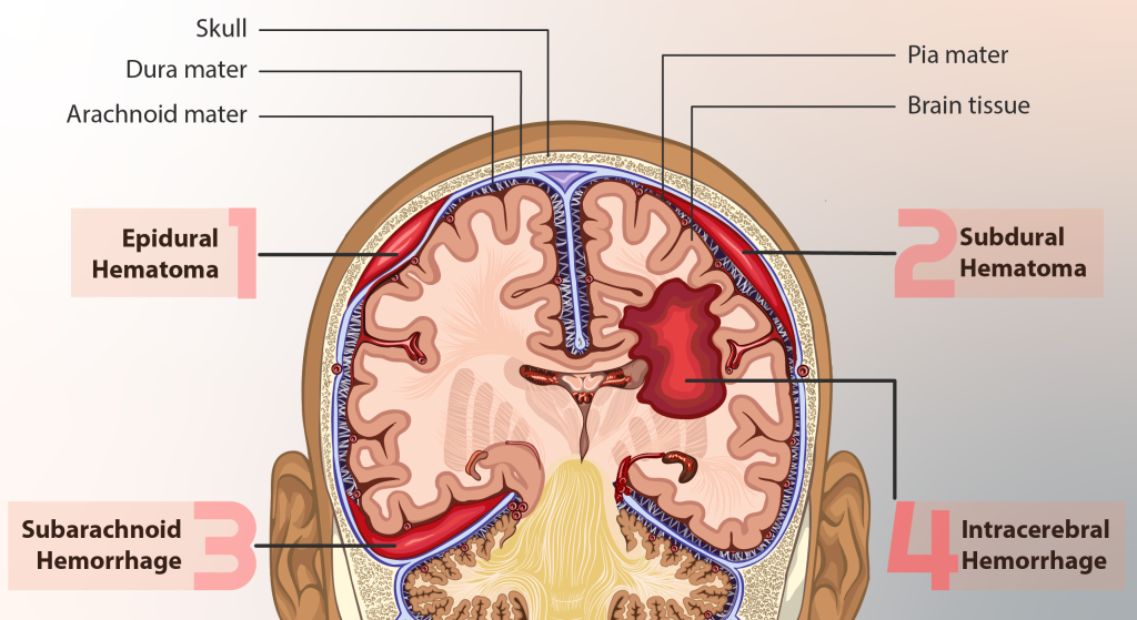 A frontal cross section of the head with the four different ways bleeding can occur: 1) epidural hematoma is between the skull and the dura 2) subdural hematoma is blood trapped between the dura and underlying arachnoid mater 3) subarachnoid hematoma is blood trapped between the arachnoid and pia mater 4) Intracerebral hemmorrhage is an accumumulation of blood anywhere within the brain itself