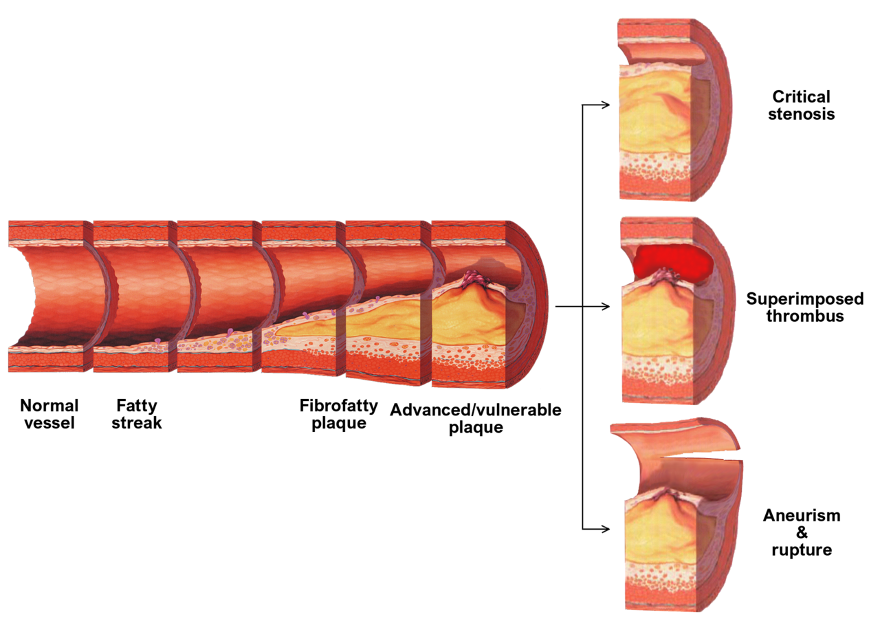 an artery is split into six segments, with a wall removed to demonstrate the development of an atherosclerotic plaque across the three tunics. The normal vessel demonstrates a smooth red surface. As the artery develops a fatty streak, the cells in the subendothelial layer gets thicker, narrowing the vessel lumen minimally. As the fatty streak develops into a fibrofatty plaque, a thick yellow plaque develops between the endothelial and smooth muscle layer, greatly reducing the vessel luminal opening. The advanced/vulnerable plaque is then split into three possible consequences: critical stenosis where the yellow fatty plaque takes up almost the entire luminal space; superimposed thrombus where the yellow plaque takes up most of the space, but a blood clot has formed in the luminal space; and Aneurysm and rupture where the blood vessel itself tears at the level of where the small luminal space was still open.