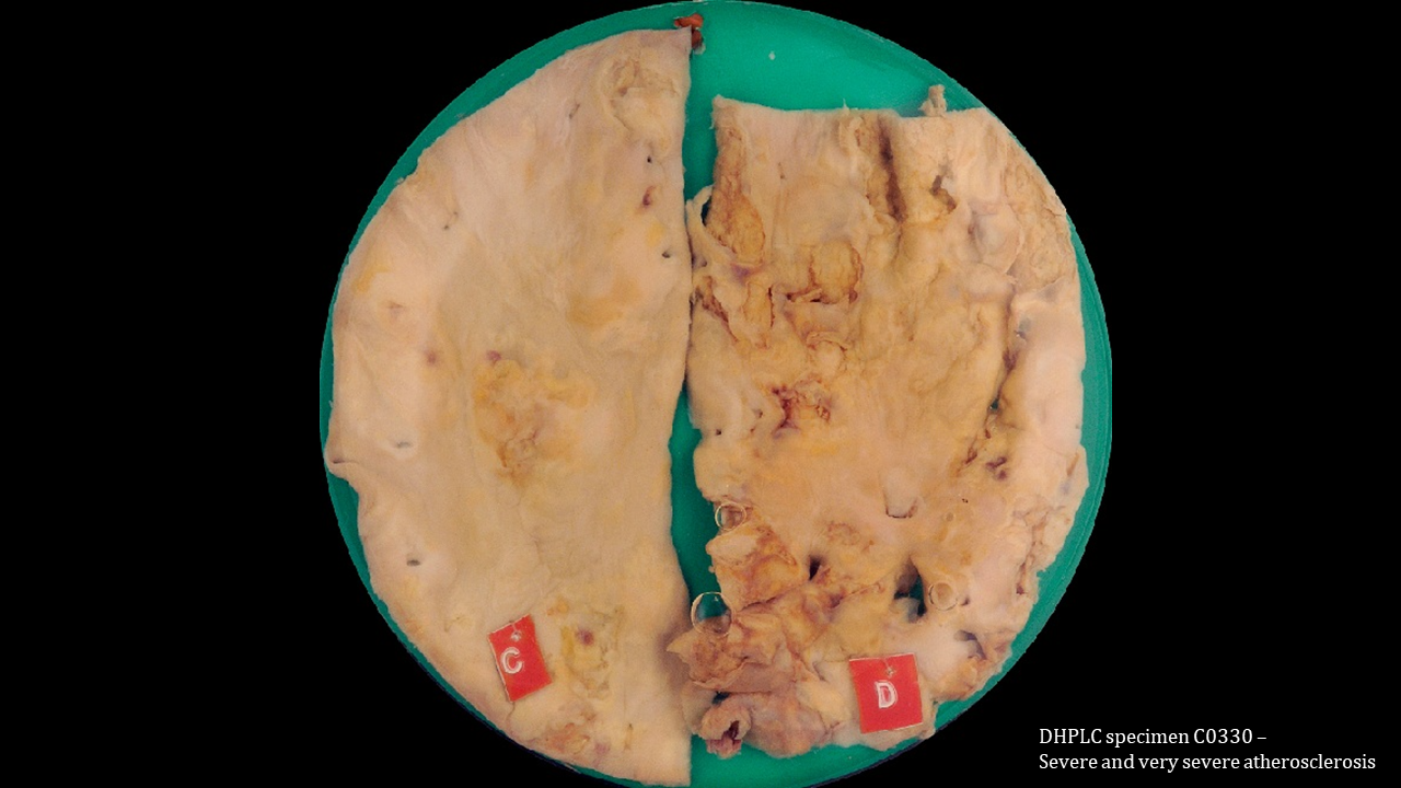 Two specimens of aorta, cut so that the intimal space is visible. The left specimen is an aorta with severe atherosclerosis which is mostly white/yellow streaks but the surface is bumpy/shaggy. The right specimen is an aorta with severe atherosclerosis. The entire surface is bumpy, covered with multiple yellow/orange plaques.