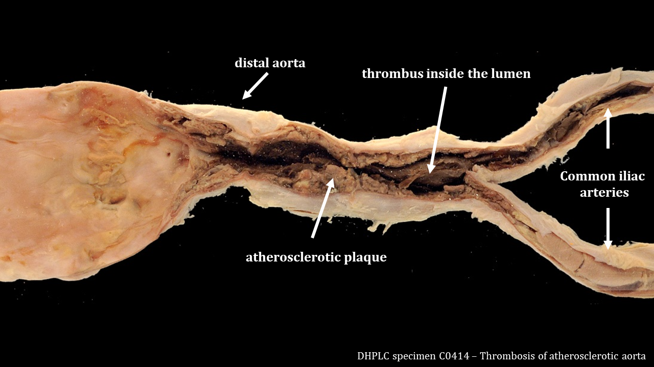 the abdominal aorta is cut open to reveal the inner intimal surface. On the left of the image, the proximal aorta shows yellow-white atherosclerotic plaques. In the middle of the image, the entire luminal space is filled with a dark blood thrombus (clot) centered around a shaggy atherosclerotic plaque with a needle-thin opening for blood. The right image shows the abdominal aorta splitting into the two common iliac arteries.