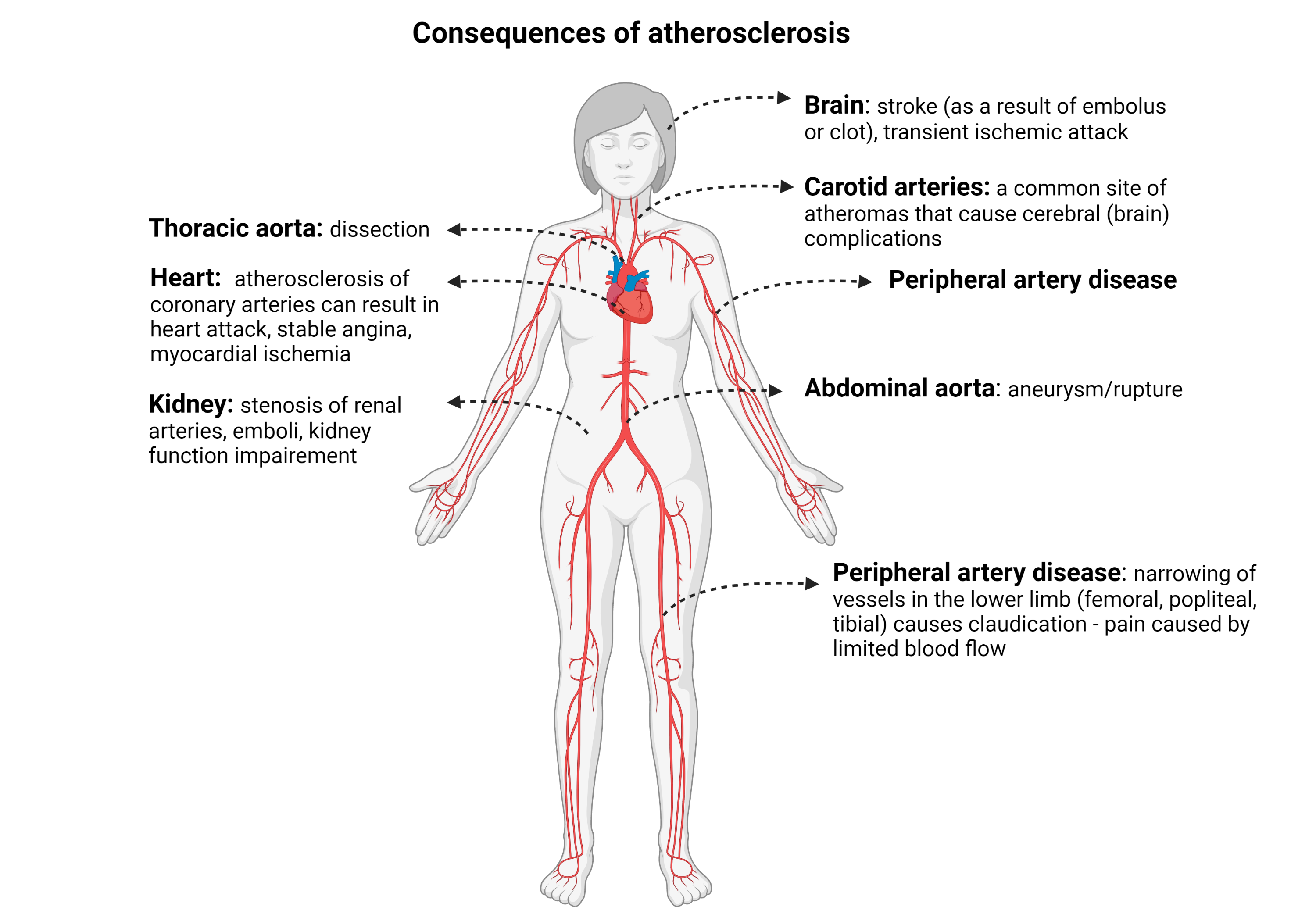 The major arteries of the body are visible with arrows pointing to common areas of atherosclerotic changes: brain, carotid (neck), thoracic (chest), heart, kidney, abdominal, and peripheral arteries (upper & lower limbs)