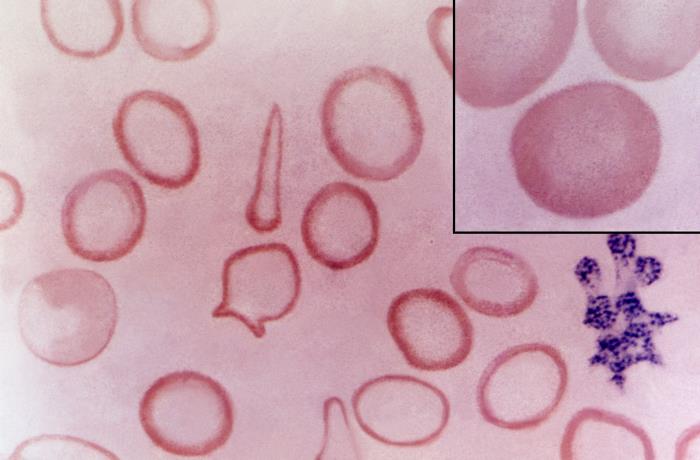 A blood smear of very hollow, red rimmed erthyrocytes that are small and hypochromic, indicative of iron deficiency anemia. Center of the image is a 'pencil cell' which is commonly seen in this type of anemia. The inset has normal RBCs to compare for size and colour