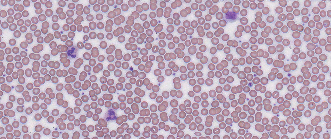 Blood looked under the microscope. The field is filled mostly with mature red bloods cells that look like pink circles with white centres. There is an occasional small circle of dark purple, suggestive of platelets. There are 3 larger cells with dark purple C-shaped nuclei indicating white blood cells