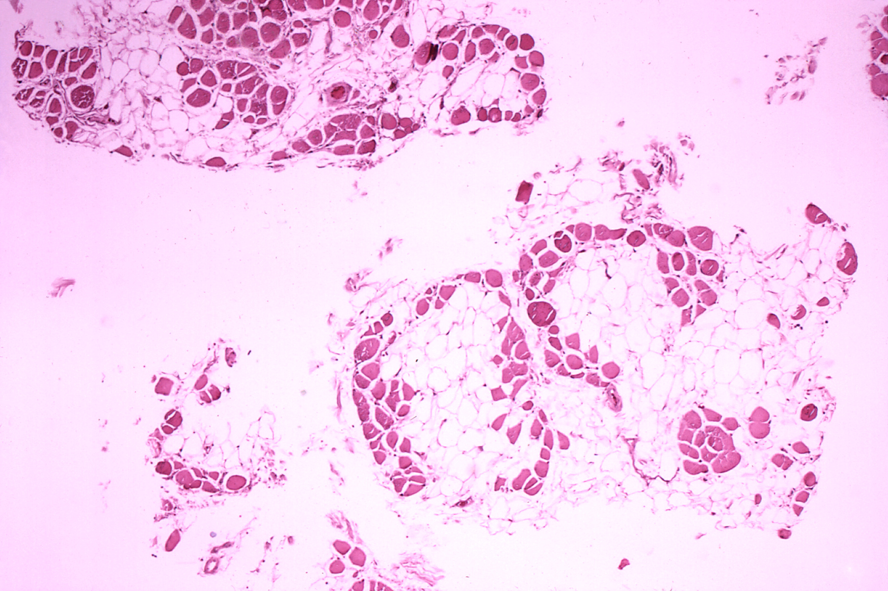 More details Histopathology of gastrocnemius muscle from patient who died of pseudohypertrophic muscular dystrophy, Duchenne type. Cross section of muscle shows extensive replacement of muscle fibers by adipose cells.