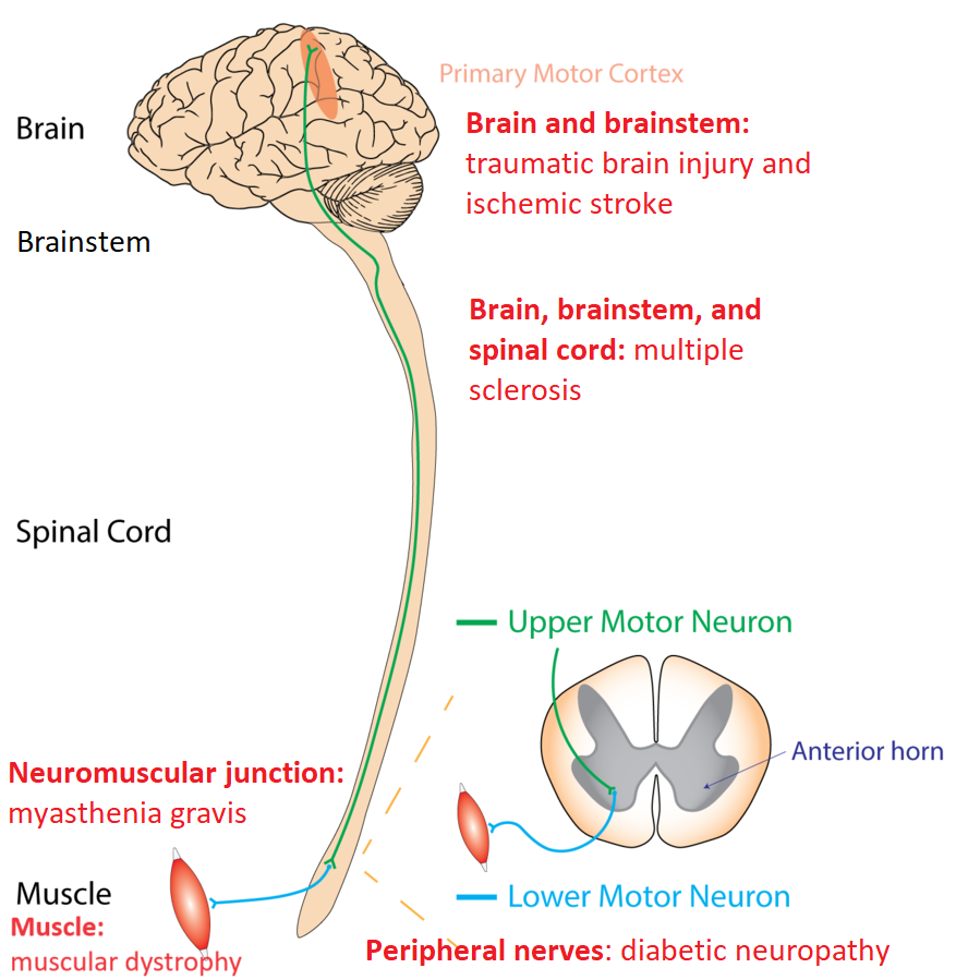 a green line denotes the motor message leaving along the upper motor neuron (i.e. the CNS from primary motor cortex through the spinal cord) to the lower motor neuron (peripheral nervous system). Red text denotes the five exemplars of pathologies: TBI & ischemic stroke for Brain, Multiple sclerosis for brain spinal cord, myasthenia gravis for neuromuscular junction, diabetic neuropathy for peripheral nerves, and muscular dystrophy for muscle