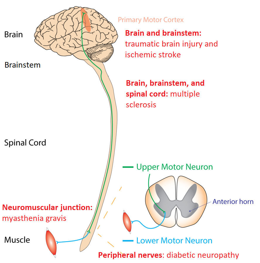 a green line denotes the motor message leaving along the upper motor neuron (i.e. the CNS from primary motor cortex through the spinal cord) to the lower motor neuron (peripheral nervous system). Red text denotes the five exemplars of pathologies: TBI & ischemic stroke for Brain, Multiple sclerosis for brain spinal cord, myasthenia gravis for neuromuscular junction, diabetic neuropathy for peripheral nerves, and muscular dystrophy for muscle