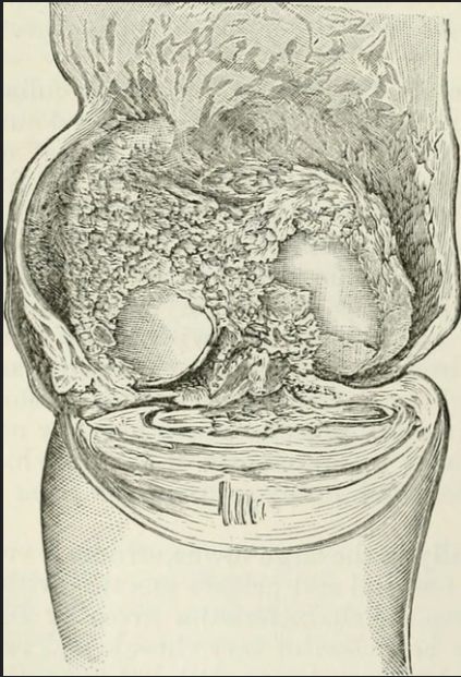 Illustration of pannus formation, showing extreme damage and inflammation of joint