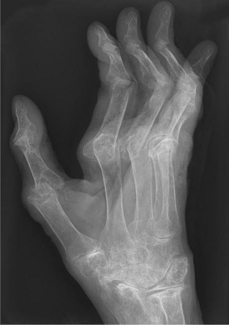 X-ray showing deformed hand of Rheumatid Arthritis patient