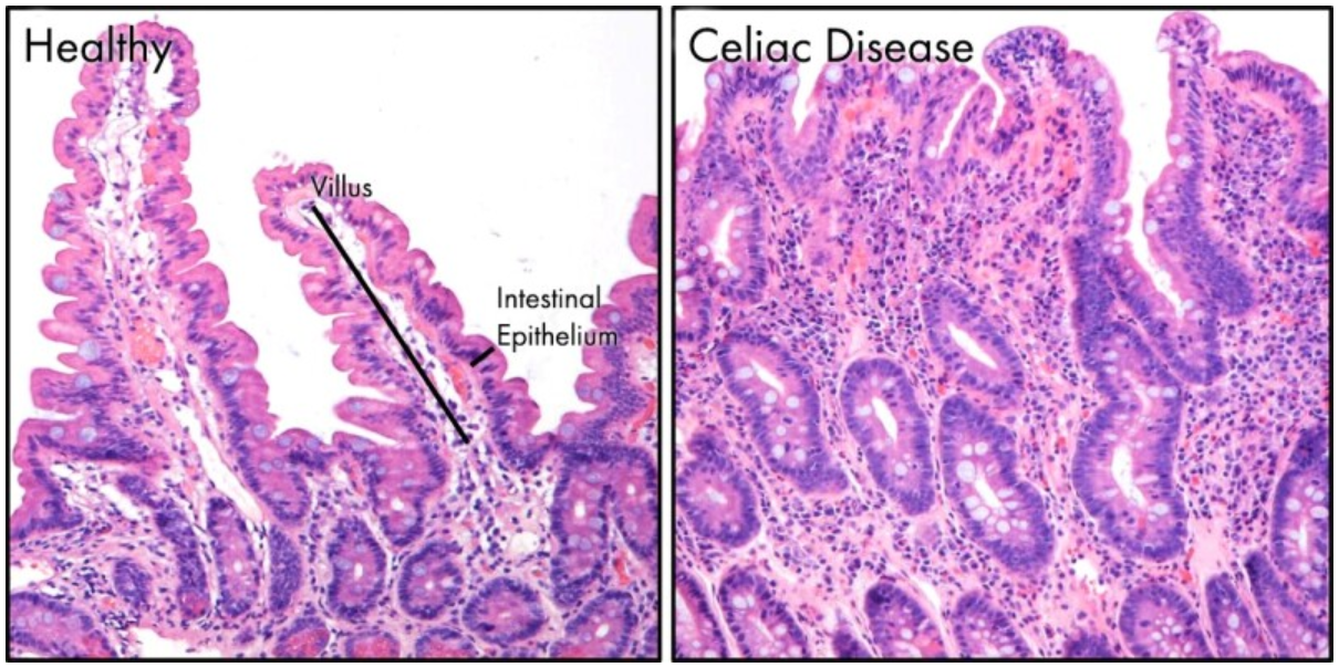 left shows villi of healthy individual. Right shows villi of celiac after exposure to gluten