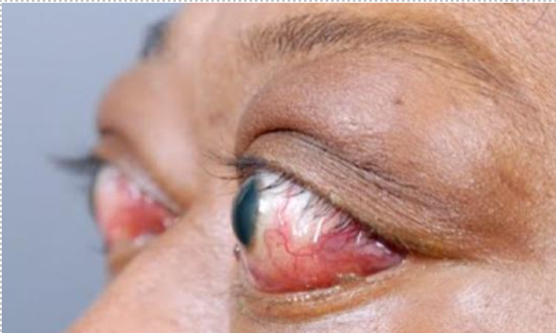 Graves' disease induced ophthalmopathy