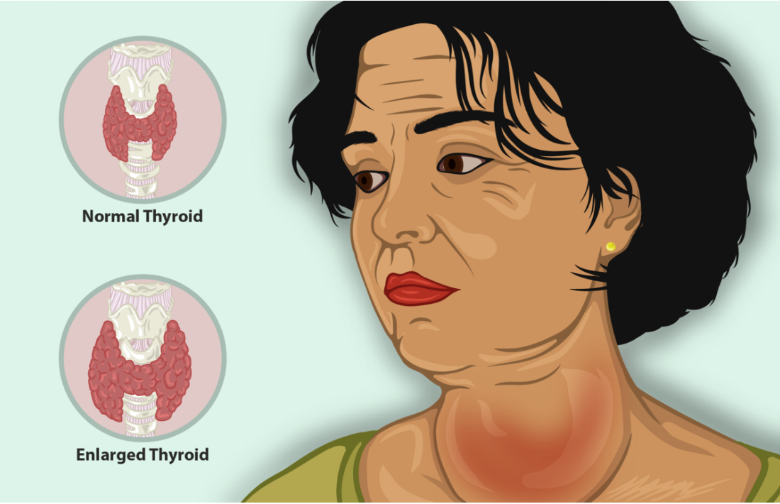 Thyroid enlargement, a symptom of hyperthyroidism can result in a structure called a Goiter