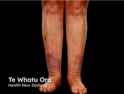 Graves induced dermopathy, most commonly resulting in non pitting edema on the shins