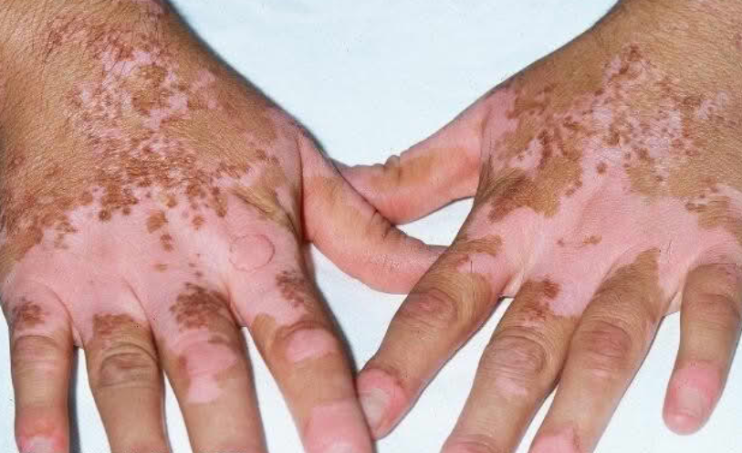 Example non-segmental vitiligo in a patient hands