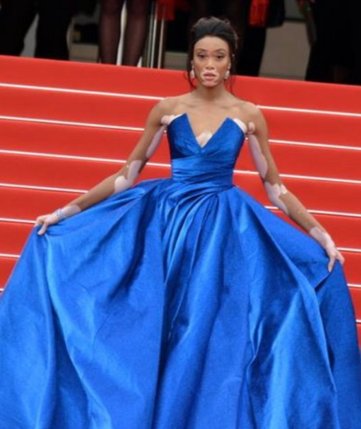 Winnie Harlow is a world famous fashion model with vitiligo. She is a spokesperson in the ongoing movement of vitiligo representation and awareness.