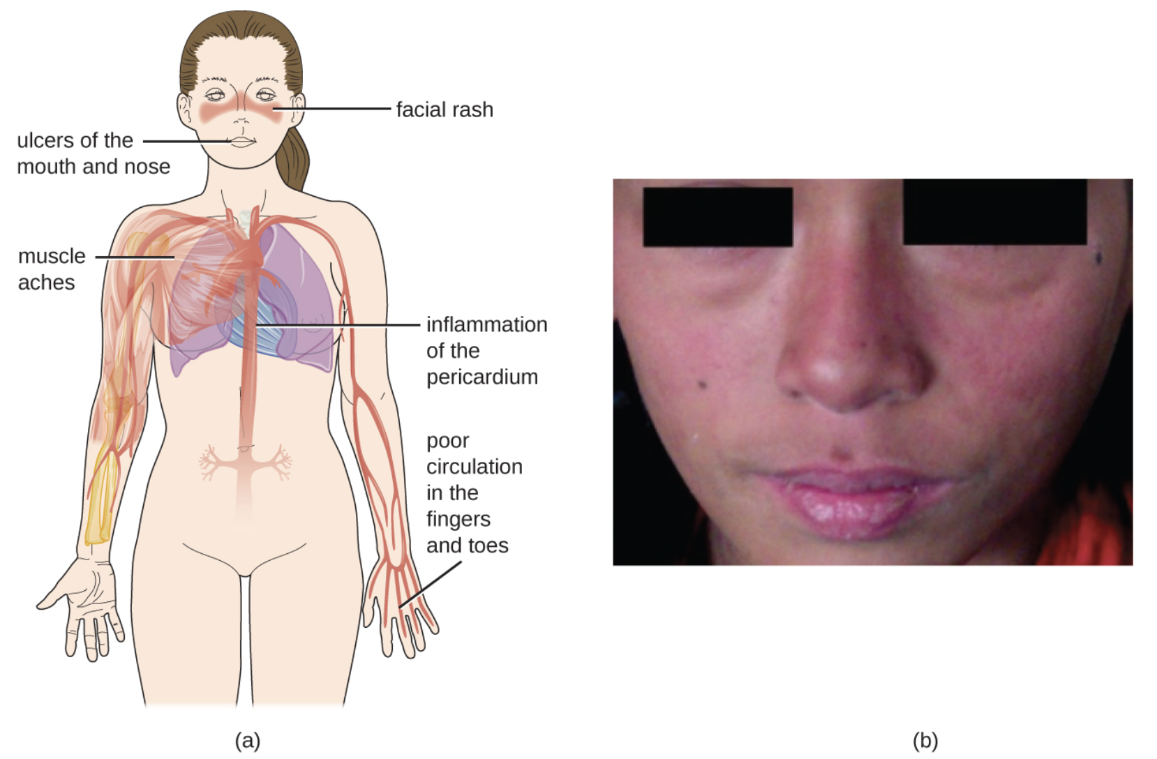 malar rash and other symptoms