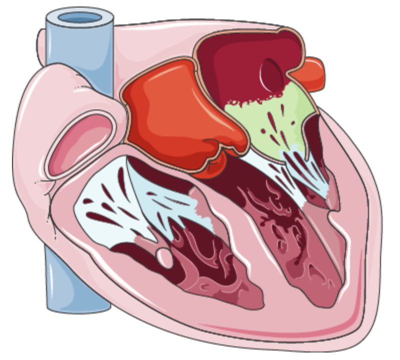 Libman Sacks Endocarditis