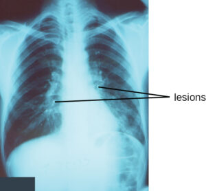 Chest X-ray showing the lungs with white radioopaque areas marked by arrows, indicating lesions consistent with pneumonia-related consolidation.