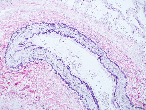 A cross-section of a normal muscular pulmonary artery from the lung, stained with an elastic tissue stain. The stain reveals two prominent, wavy, dark purple elastic layers: the internal elastic lamina and the unique external elastic lamina. A tunica media of smooth muscle is present between them.