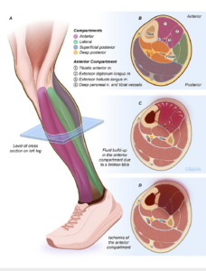 Acute Compartment Syndrome of the Lower Limb Figure 1a -Healthy lower limb cross-section of L4 dermatome. Figure 1b -Four compartments of a healthy lower limb: anterior, lateral, superficial posterior, and deep posterior. The anterior compartment is most commonly involved in ACS and contains muscles such as the tibialis anterior, extensor hallucis longus, extensor digitorum longus, and the deep peroneal nerve. Figure 1c -ACS developing following a tibial fracture. Fluid in the compartments increases pressure within the anterior compartment causing compression of vasculature and muscles. Figure 1d -Tissue ischemia and necrosis of the lower limb ensue when treatment is not obtained.