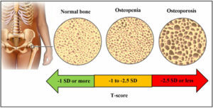 Comparative view of normal bone, osteopenia, and osteoporosis.  A T score is a comparative measure of bone density between the patient's bone density and that of a healthy young adult (T score of young healthy adult = 0).  A patient's T score of +/- 1 SD is considered normal.  A T score between -1 to -2.5 is characteristic of osteopenia.  A T score lower than -2.5 is characteristic of osteoporosis.