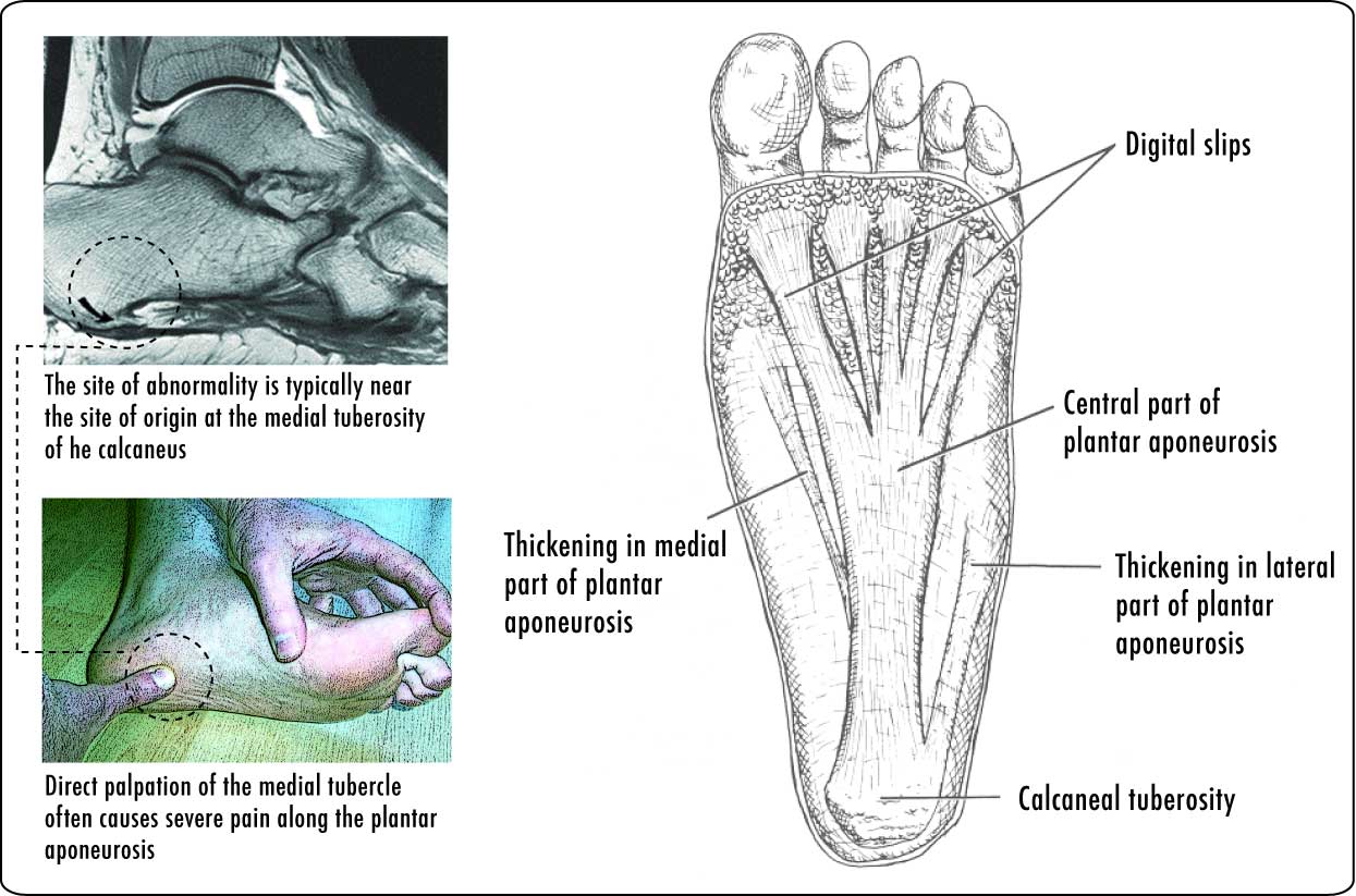 Plantar Aponeurosis