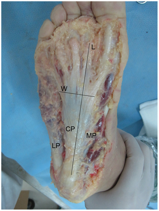 Figure 1. Axial view of the plantar aponeurosis.LP, lateral part; CP, central part; MP, medial part; L, length; W, width.