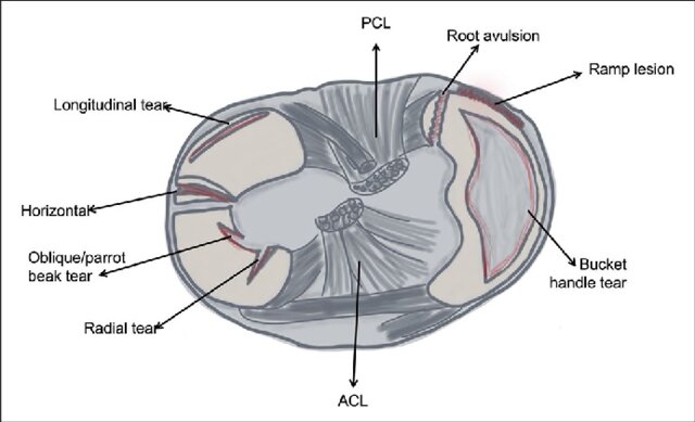 Representation of all meniscal tear patterns.