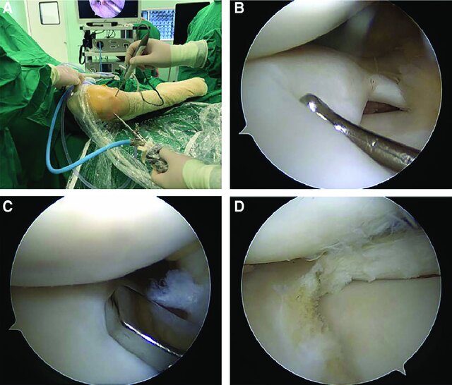 "Surgical procedures of arthroscopic meniscoplasty. (A) The patients were placed in a supine position, and the standard anterolateral and anteromedial arthroscopic portals were established. (B) With the assistance of the probe hook, the knee was examined thoroughly to confirm the torn position and shape of the DLM. (C) The torn and hypertrophic parts of DLM were removed by basket forceps. (D) DLM was trimmed into "C" shape, and the edge of the meniscus with a width of at least 5 to 6 mm was cautiously retained. DLM = discoid lateral meniscus."