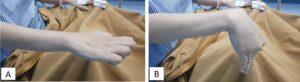 Moderate Volkmann Contracture of the right forearm in a 34-year-old woman. The fingers were fixed in flexion when the wrist in extension. The finger could not be brought into full passive extension (A). The fingers could be extended when the wrist was flexed (B).