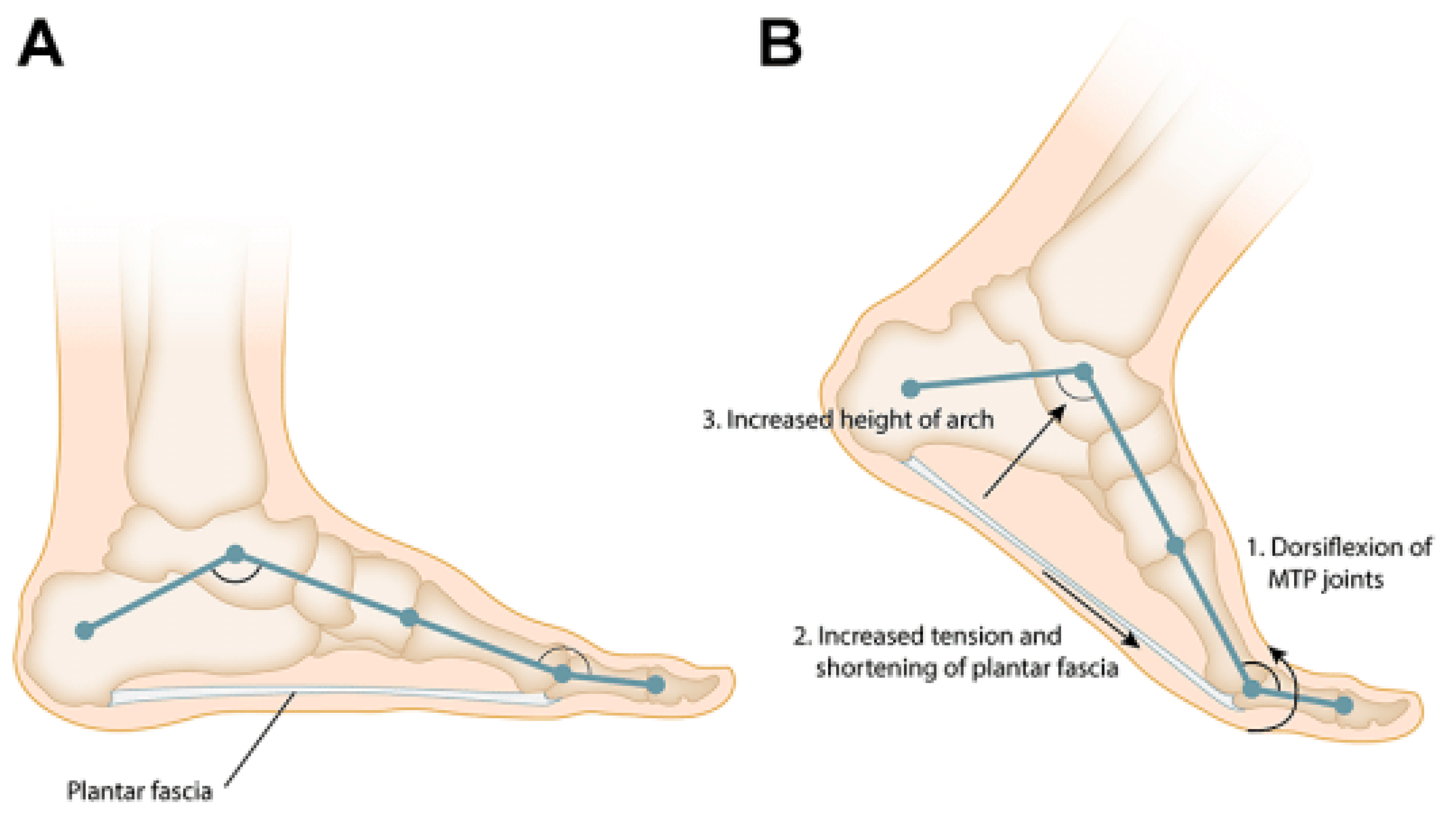 Figure 2. (A) The plantar fascia and the longitudinal arch of the foot form a truss. (B) Dorsiflexion of the toes during the late stance phase of gait tensions the plantar fascia around the metatarsal heads leading to an increase in the height and stability of the longitudinal arch of the foot “Windlass” mechanism. Source: Reprinted from Latt L.D.; Jaffe, D.E.; Tang, Y. Evaluation and Treatment of Chronic Plantar Fasciitis. Foot Ankle Orthop. 2020 [9] (SAGE Open access licensed under CC BY-NC-SA 4.0, no permission required).