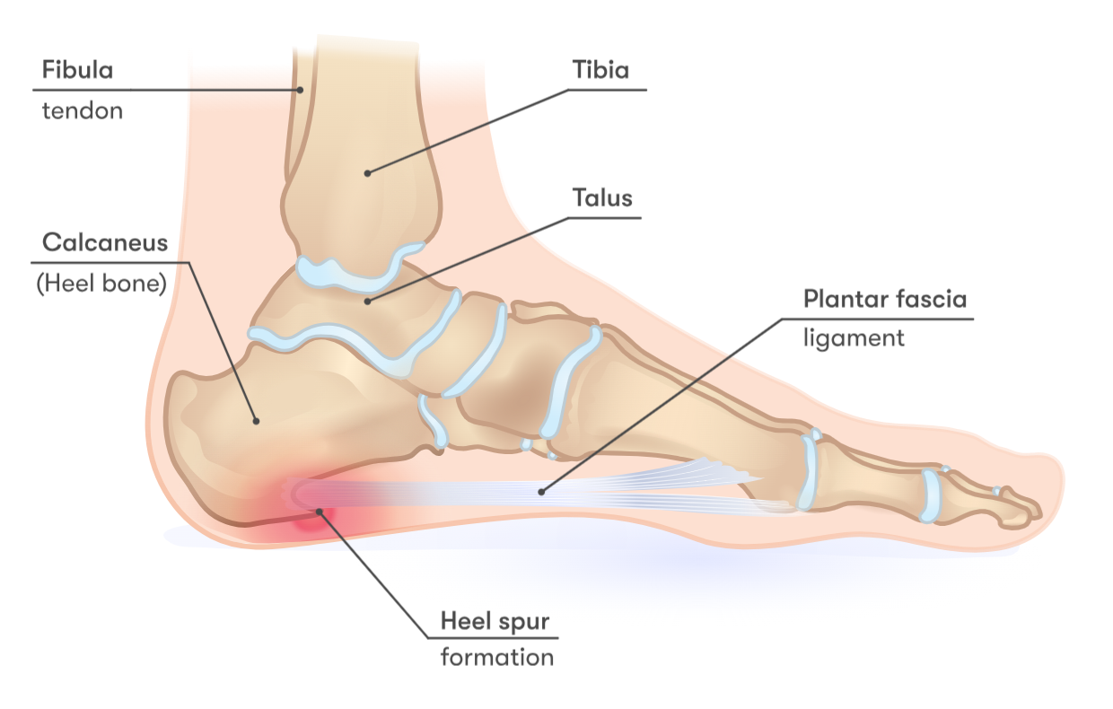 Medical illustration of the bones of a human foot, showing the formation of a heel spur.