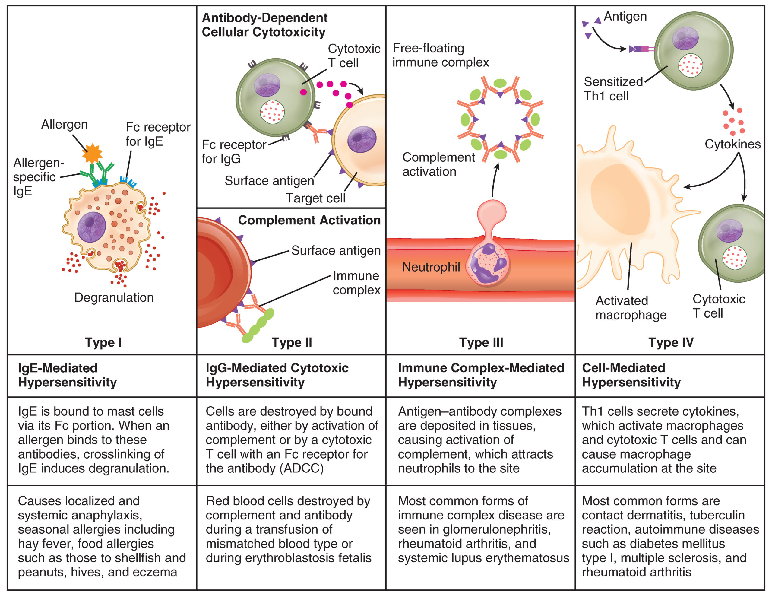 Figure. Immune Hypersensitivity Components of the immune system cause four types of hypersensitivity. Notice that types I–III are B cell mediated, whereas type IV hypersensitivity is exclusively a T cell phenomenon.