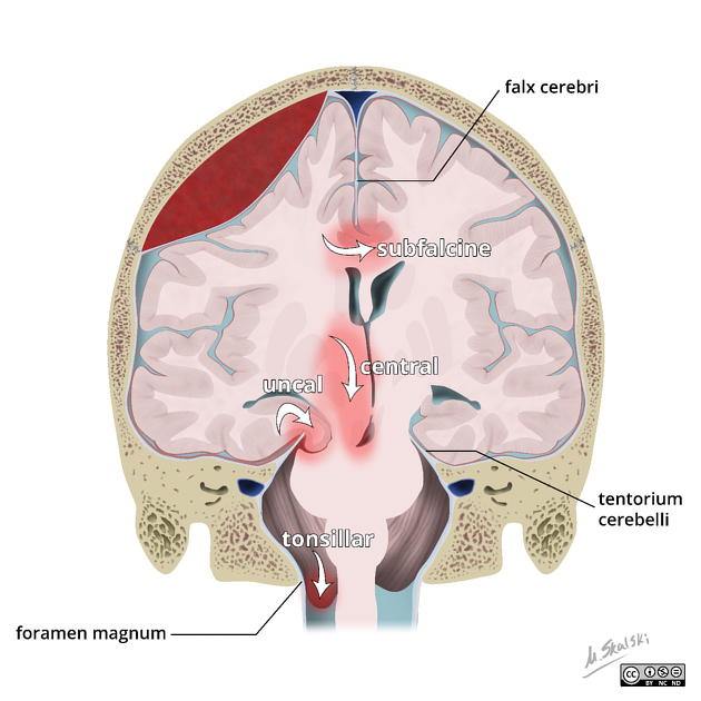 Brain herniation types.