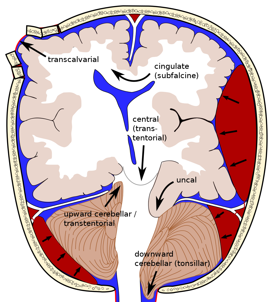 Types of Brain Herniations.