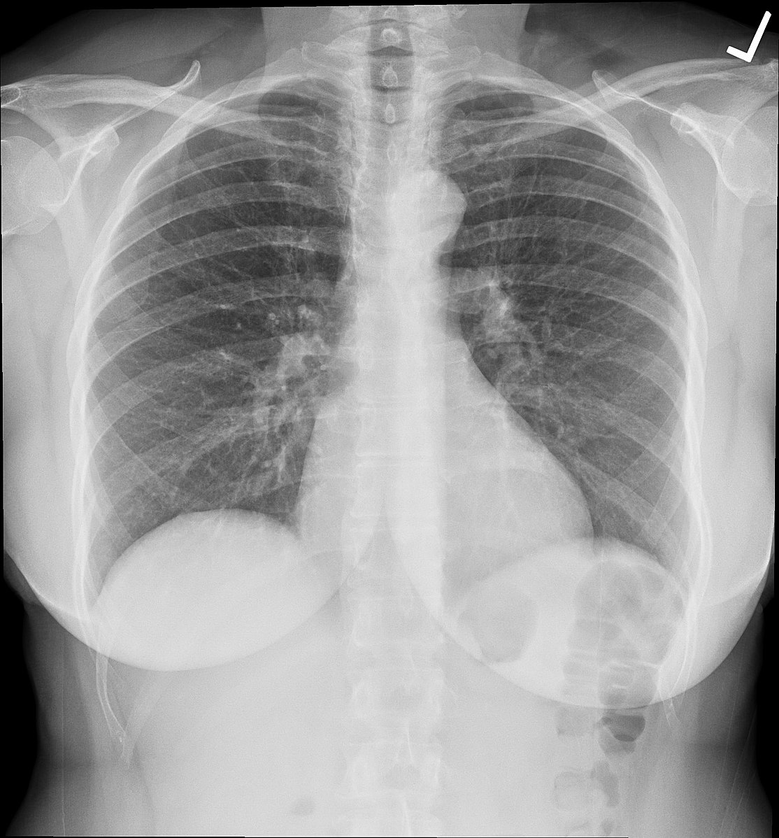 Chest X-ray (Normal)