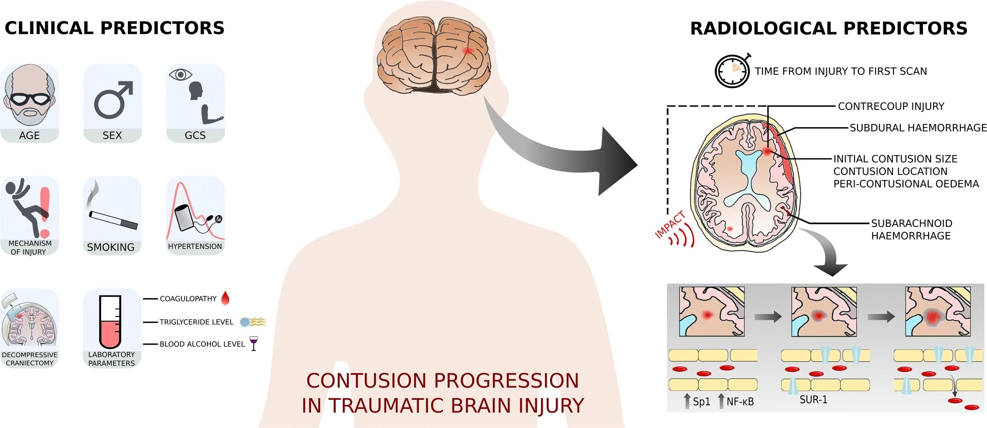 Mechanism of contusion progression and its clinical and radiological predictors. Kinetic energy delivered to mechanosensitive endothelial cells during impact induces upregulation of specificity protein 1 (Sp1) and nuclear factor-ĸB (NF-ĸB) which, in turn, upregulates sulfonylurea receptor 1 (SUR-1). There is a resultant increase in blood–brain barrier permeability and edema formation, followed by capillary fragmentation and extravasation of blood, i.e., contusion progression.