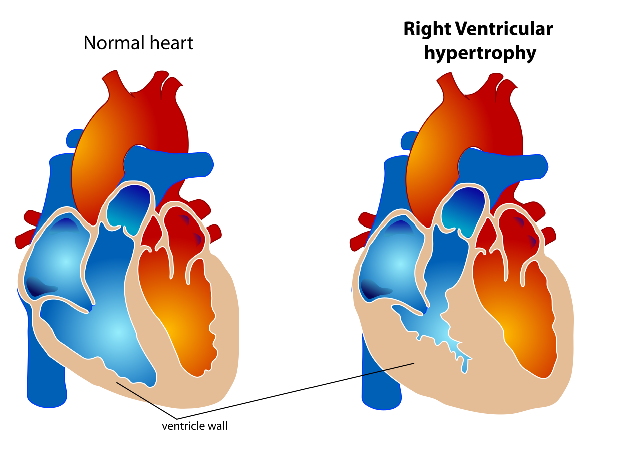 Right Ventricular Hypertrophy