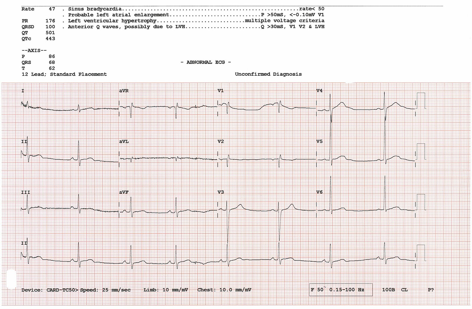 An Electrocardiogram Diagram