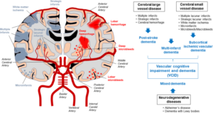 Cerebral vascular lesions and vascular cognitive impairment and dementia.