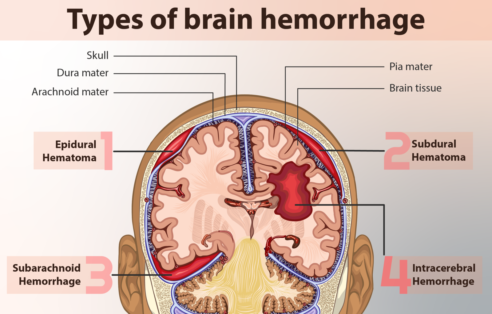 An illustration of Subarachnoid hemorrhage.
