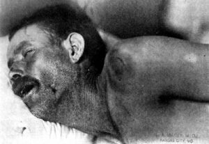 Neck stiffness cropped.