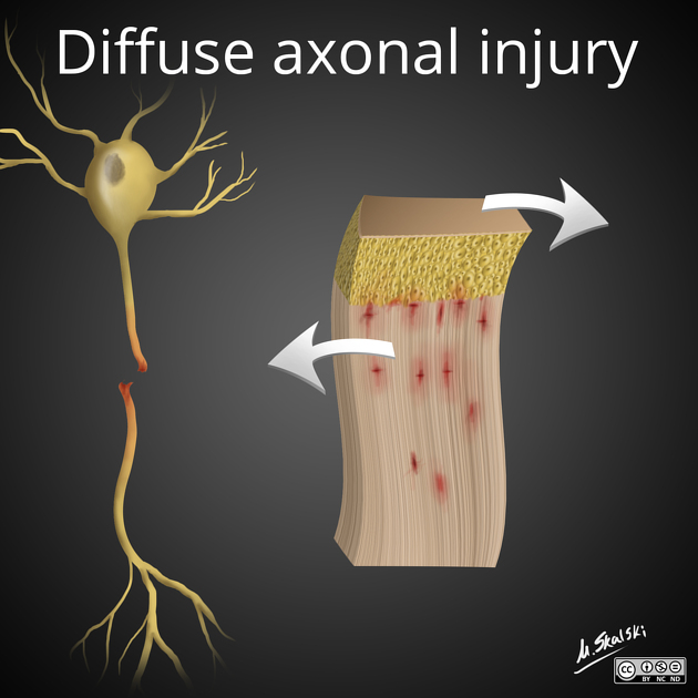 Diffuse axonal injury: illustration.