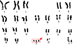 Example of congenital multifactorial defect: down syndrome.