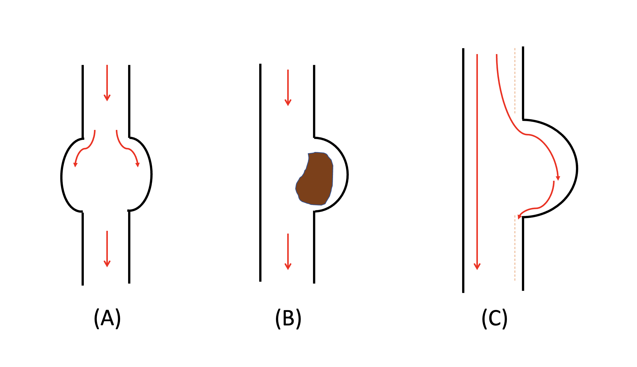 3 Types of Aortic Aneurysms