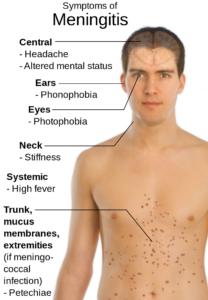 Symptoms of Meningitis.